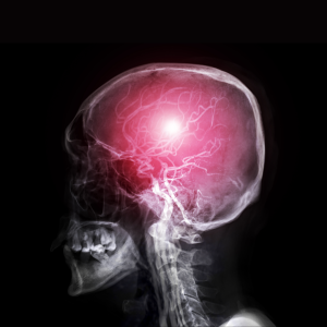 Cerebral arteries, MRI angiogram
