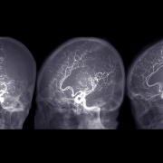 Cerebral angiography AP,Oblique and Lateral view image from Fluoroscopy