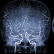 Cerebral Angiography Image