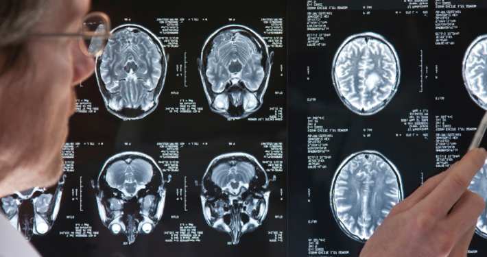 Male Doctor looking at Brain MRI Scan