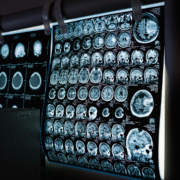 Neurological brain scan