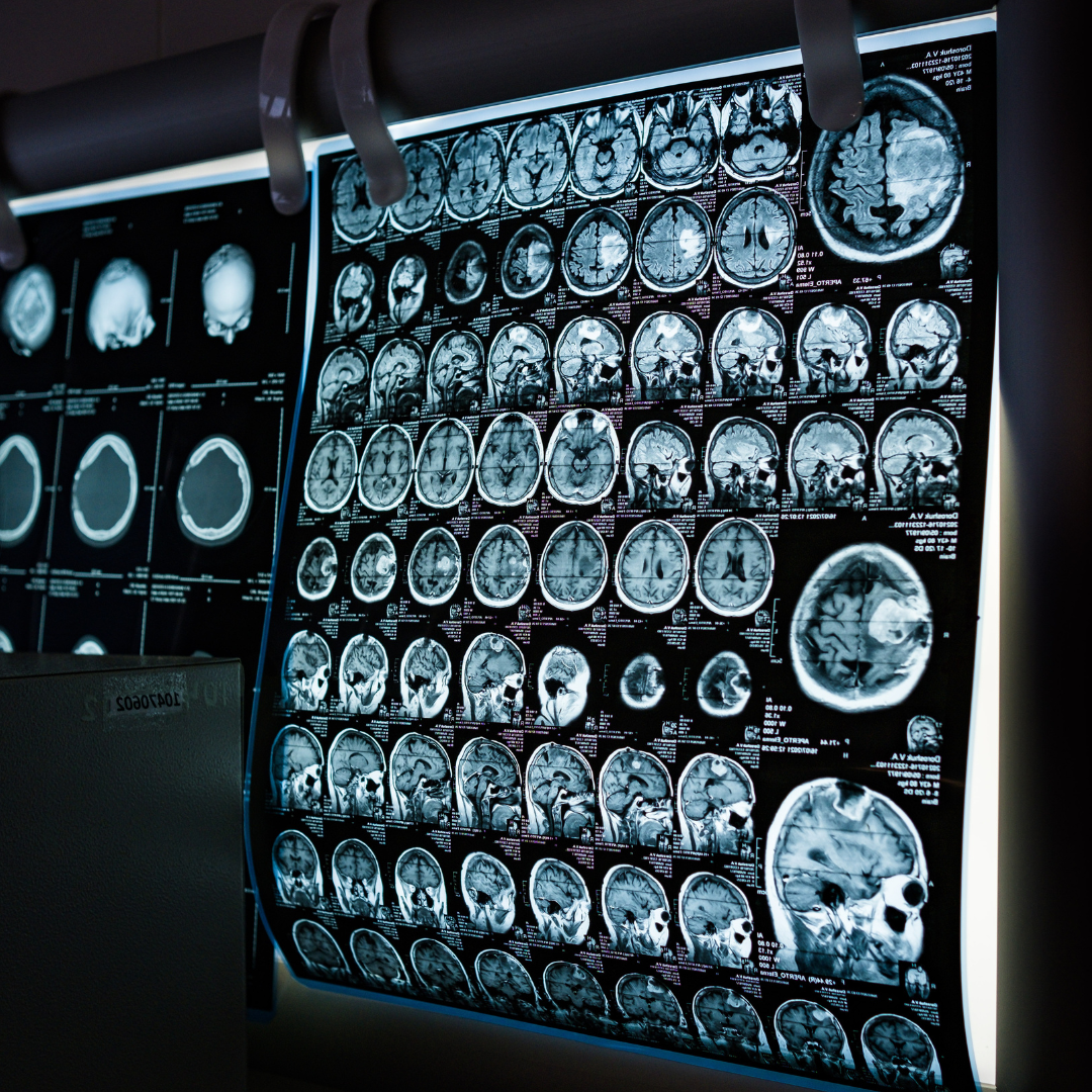 Neurological brain scan